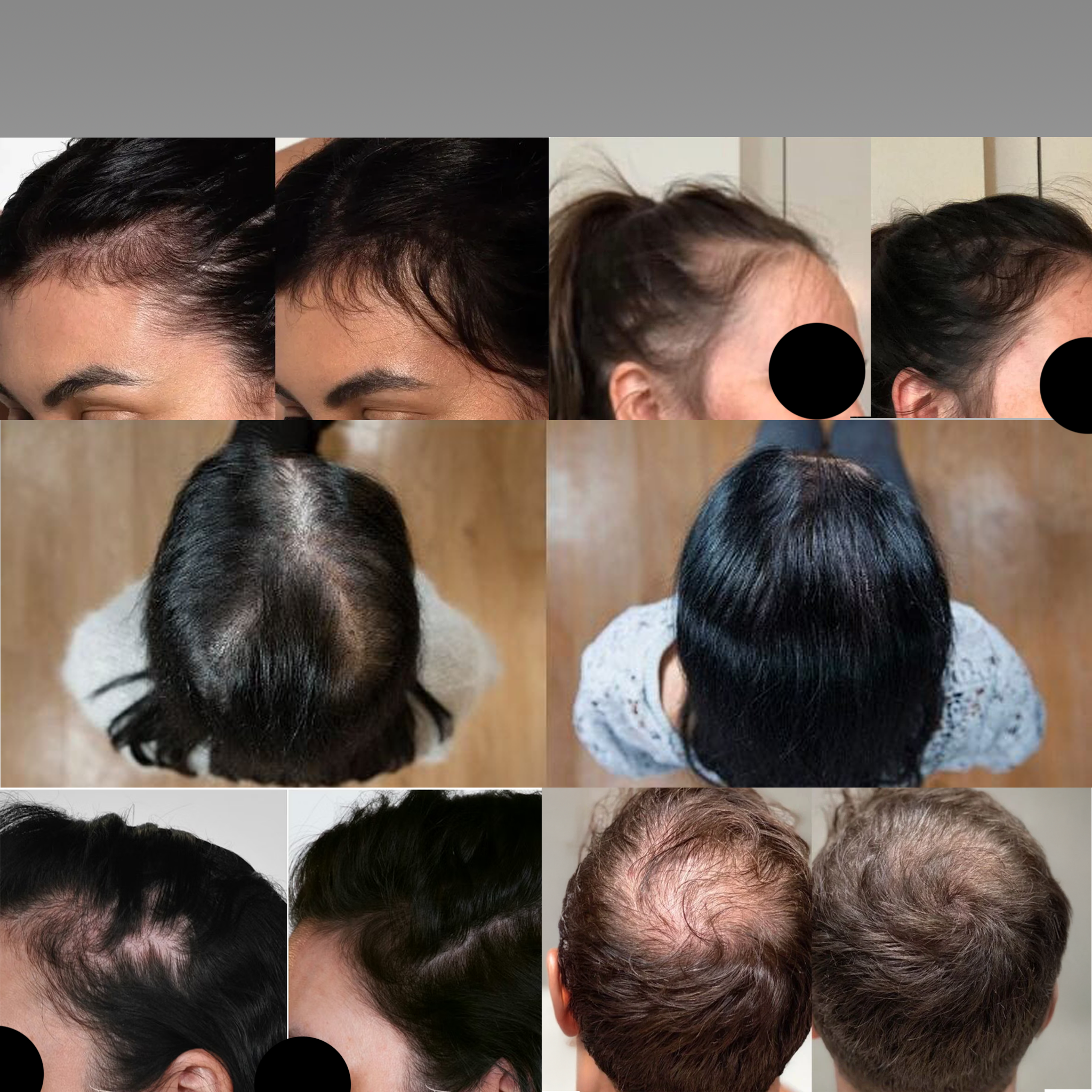 YAORA Hair Growth Spray | Fermented Rice Water